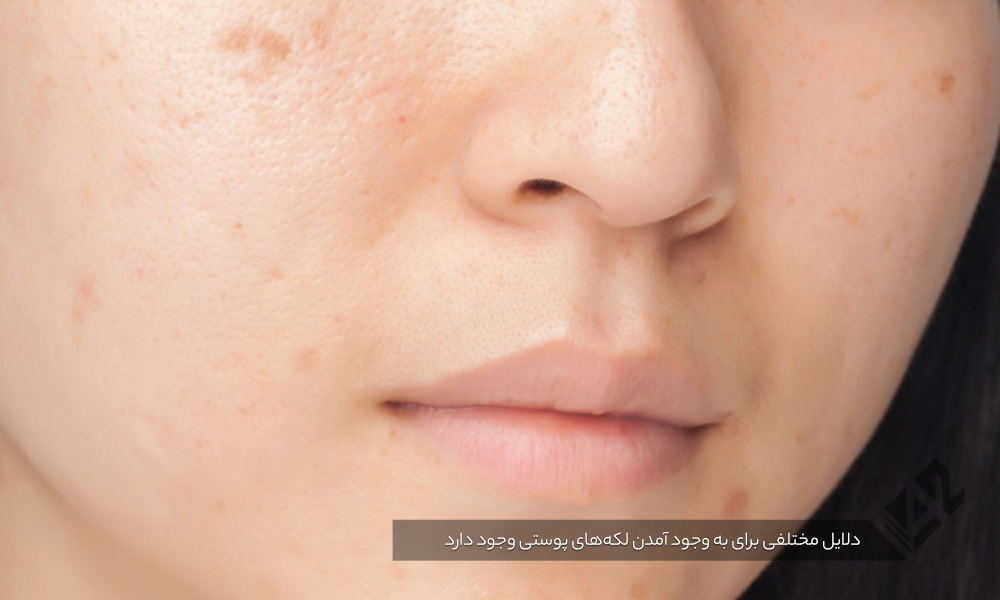 دلایل مختلفی برای به وجود آمدن لکه‌های پوستی وجود دارد