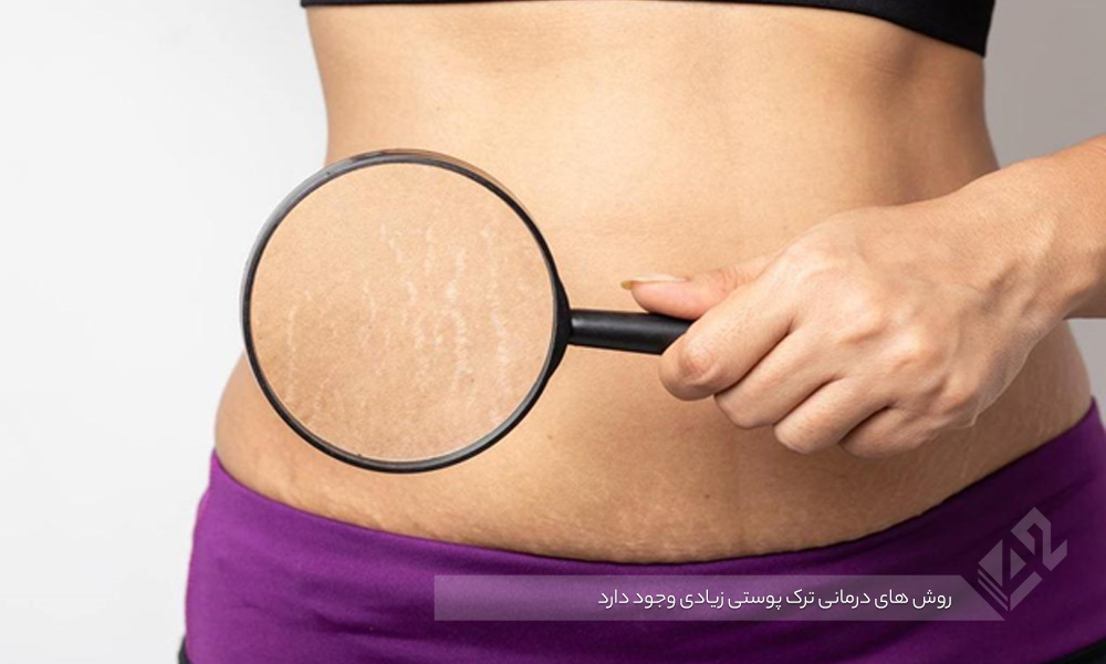 درمان ترک‌های پوستی-درمان ترک های پوستی چیست