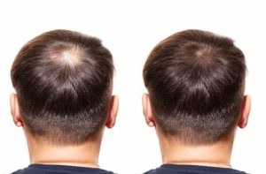 مزوتراپی یا کاشت مو؟ کدام یک تاثیر بیشتری دارد؟